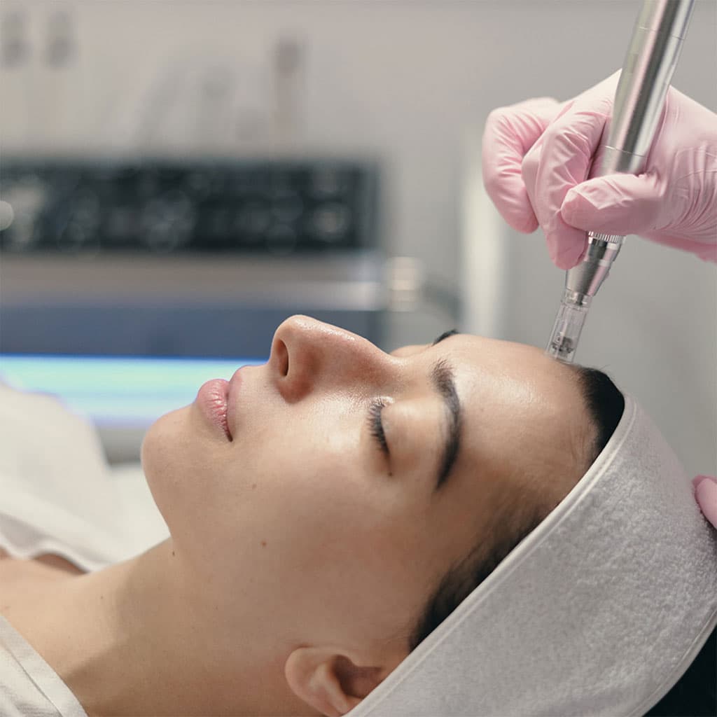Patient receiving a microneedling skin treatment